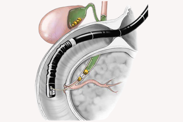 ERCP
