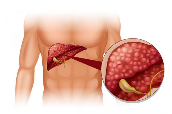 Liver Disorders
