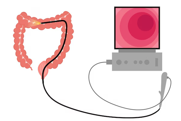 Colonscopy