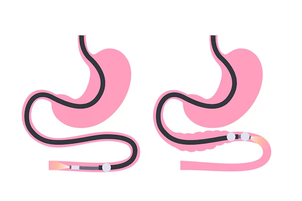 Balloon Enteroscopy