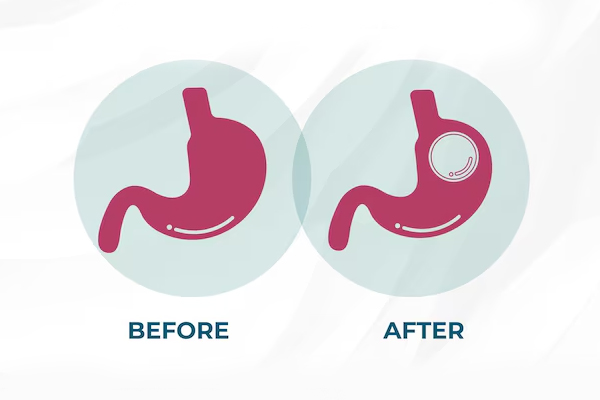 Intra Gastric Balloon