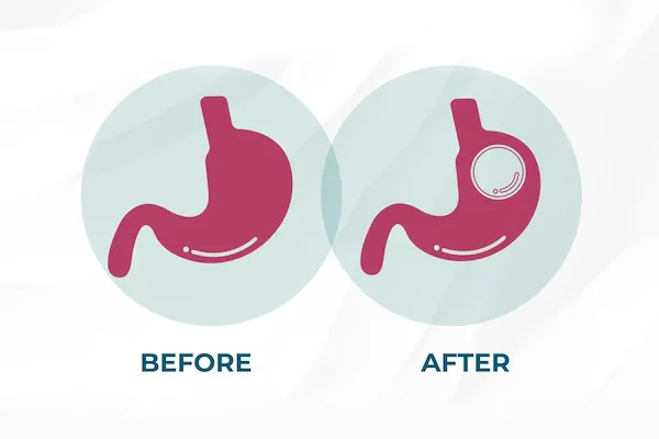 Intra Gastric Balloon
